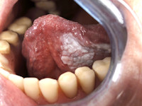 Plaveiselcelcarcinoom van de mondholte