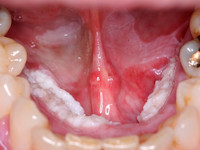 Plaveiselcelcarcinoom van de mondholte