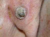Squamous cell carcinoma, carcinoma squamous cell carcinoma
