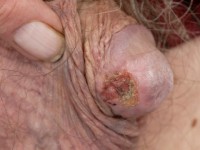 Plaveiselcelcarcinoom, carcinoma spinocellulare