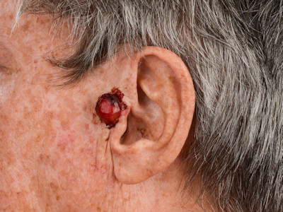 Pleiomorf dermaal sarcoom