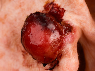 Pleiomorf dermaal sarcoom