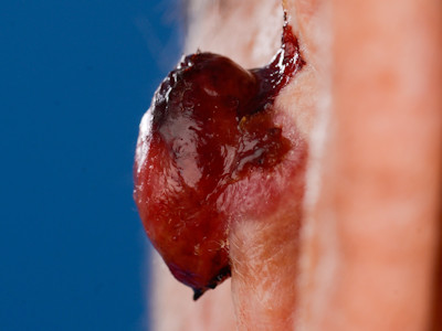 Pleiomorf dermaal sarcoom