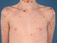 PLEVA, pityriasis lichenoides et varioliformis acuta