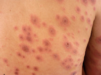 PLEVA, pityriasis lichenoides et varioliformis acuta