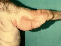 Plexiforme neurofibromen