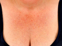 Poikiloderma van Civatte