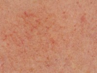 Poikiloderma van Civatte