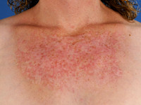 Poikiloderma of Civatte