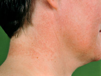 Poikiloderma van Civatte