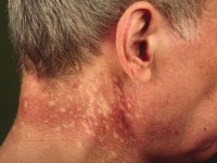 Poikiloderma van Civatte