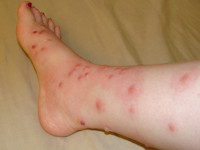 Poison Ivy dermatitis (USA)