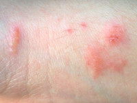 Poison Ivy dermatitis (USA)