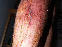 Poison Ivy dermatitis (USA)