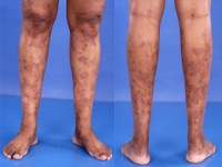 polyarteritis nodosa