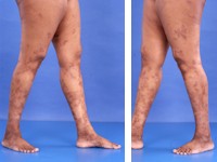 polyarteritis nodosa