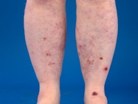 polyarteritis nodosa