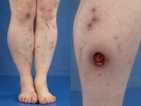 polyarteritis nodosa