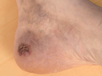 Porocarcinoom ontstaan in een eccrien poroma