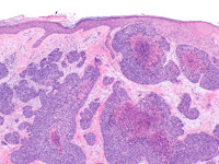 Histologie porocarcinoom
