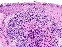 Histologie porocarcinoom
