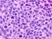 Histologie porocarcinoom