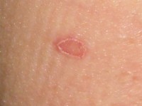 Porokeratosis van Mibelli