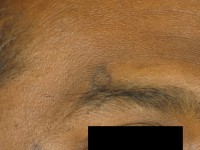 Porokeratosis van Mibelli