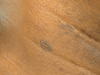 Porokeratosis van Mibelli