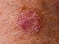 Porokeratosis van Mibelli