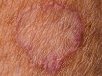Porokeratosis van Mibelli