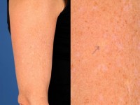Porokeratosis actinica disseminata superficialis