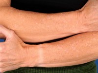 Porokeratosis actinica disseminata superficialis