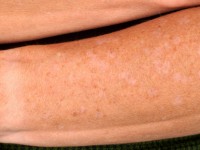 Porokeratosis actinica disseminata superficialis