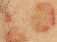 Porokeratosis disseminata superficialis