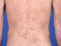 Porokeratosis disseminata superficialis