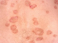 Porokeratosis disseminata superficialis
