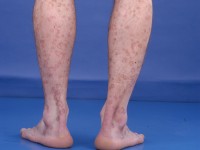 Porokeratosis disseminata superficialis