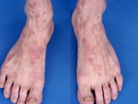 Porokeratosis disseminata superficialis