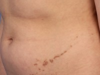 Porokeratosis linearis