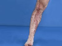 Porokeratosis linearis