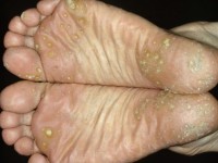 Porokeratosis palmaris et plantaris et disseminatus