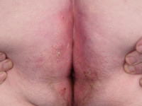 Porokeratosis ptychotropica