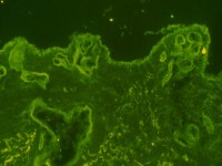 Histologie (immunofluorescentie) porphyria cutanea tarda