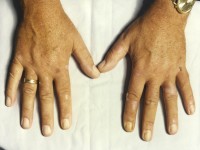 Porphyria cutanea tarda