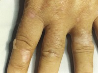 Porphyria cutanea tarda