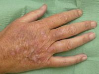 Porphyria cutanea tarda