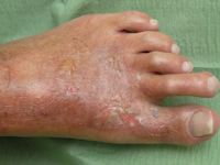 Porphyria cutanea tarda