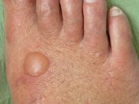 Porphyria cutanea tarda