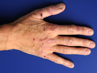 Porphyria cutanea tarda